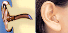 耳穴型カナル補聴器