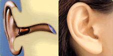超小型耳穴型補聴器